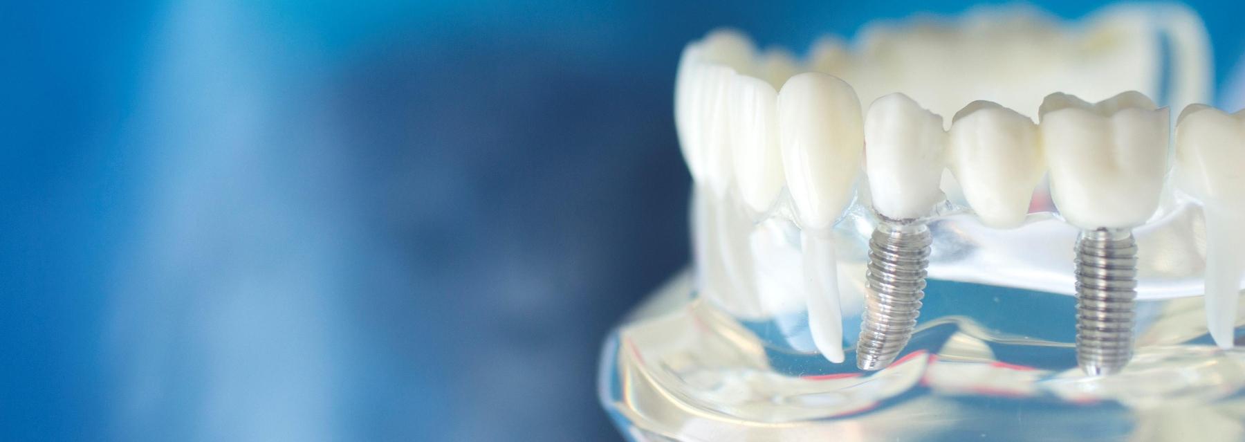 Dental implants | Dentist