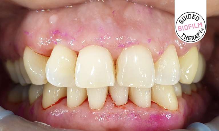 Dental-Clean-using-the-GBT-EMS-Airflow-After-Image