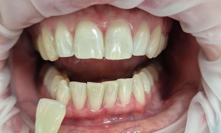 Pola-Light-Home-Whitening-System-After-Image