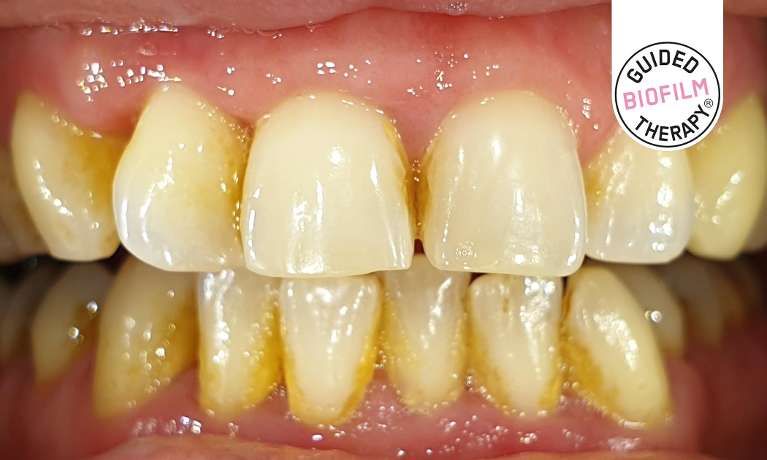 Dental-Clean-using-the-GBT-EMS-Airflow-Before-Image