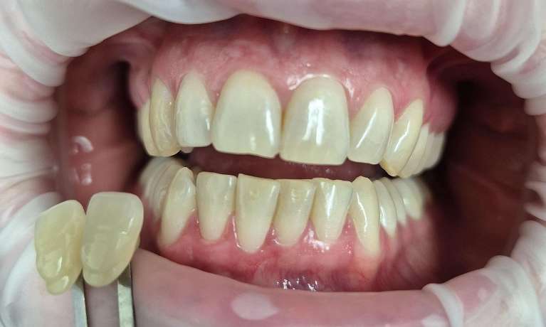 Pola-Light-Home-Whitening-System-Before-Image